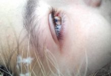 “Mušice” u vidnom polju moglu da budu znak ozbiljnog problema