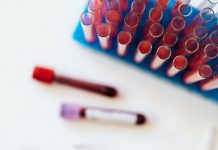 Ljudi sa ovom krvnom grupom imaju veći rizik za dobijanje moždanog udara