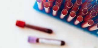 Ljudi sa ovom krvnom grupom imaju veći rizik za dobijanje moždanog udara