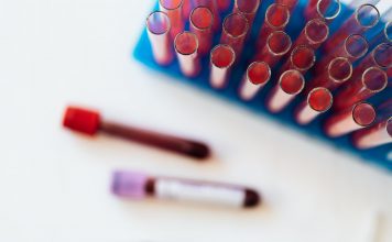 Ljudi sa ovom krvnom grupom imaju veći rizik za dobijanje moždanog udara